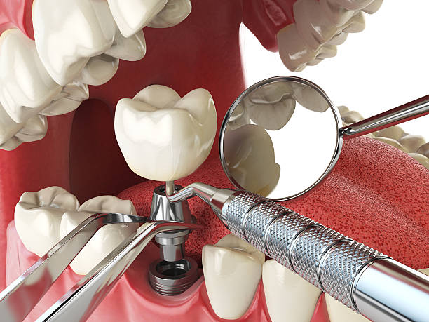 Best Emergency Treatment for Dental Infections or Abscesses in Glencoe, FL
